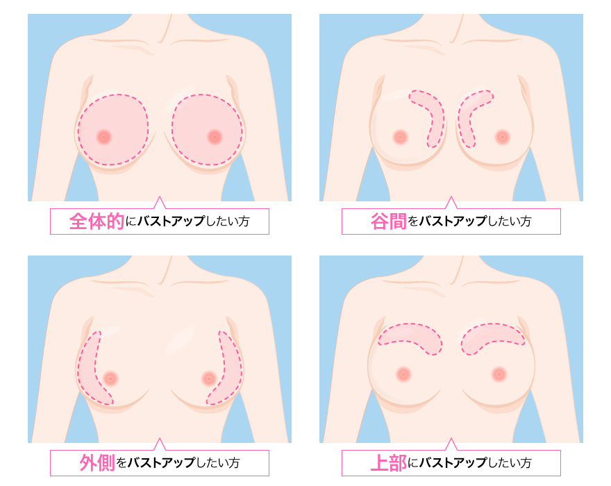 TCB式ヒアルロン酸豊胸 バストアップパターン