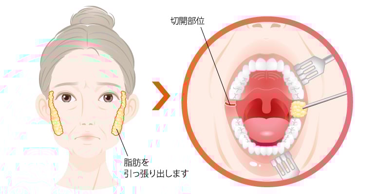 バッカルファット