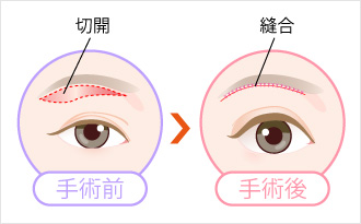 傷跡を極力目立たせない手法