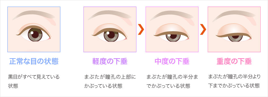 眼瞼下垂の症状がある方はご注意ください