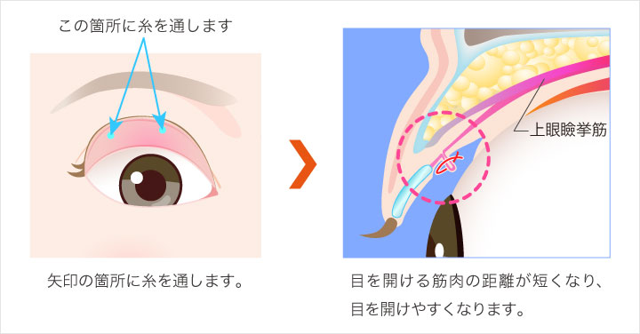 埋没式挙筋前転法