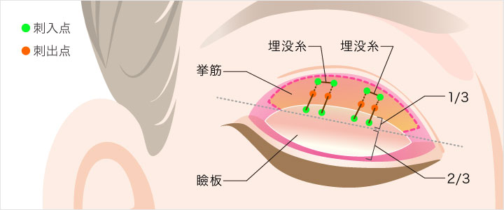 瞼板法2点留め