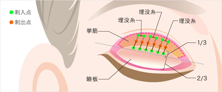 瞼板法3点留め