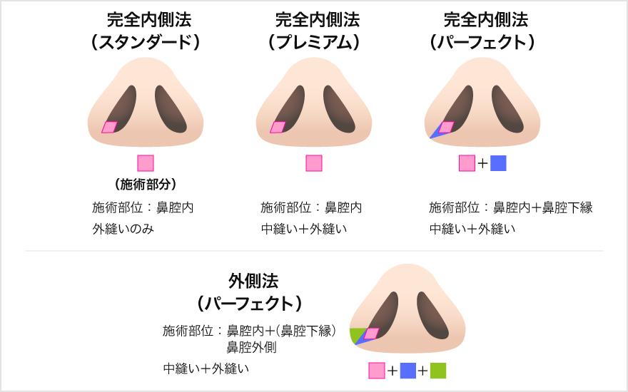 鼻翼縮小完全内側法の種類