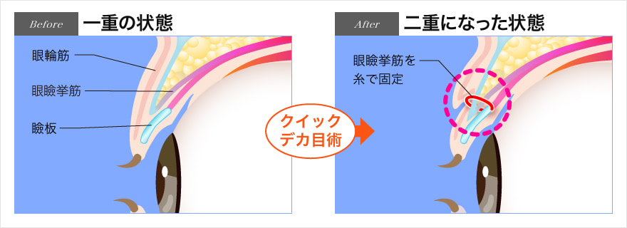 一重からクイックデカ目術によって二重に