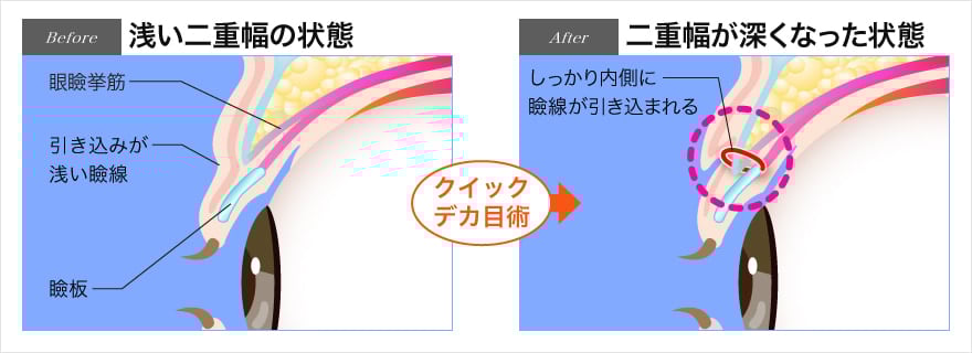 クイックデカ目術により綺麗な二重に