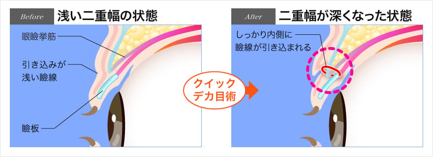 クイックデカ目術により綺麗な二重に