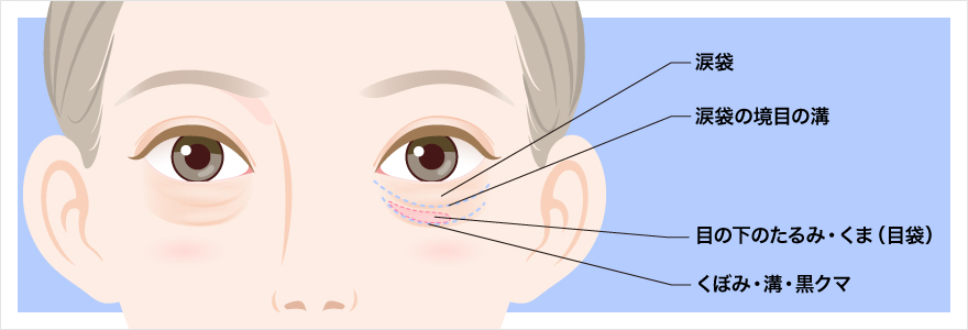 目の下のしわ・たるみの原因
