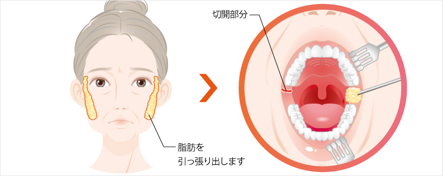 ”バッカルファット除去法