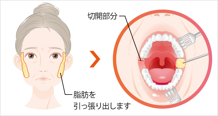”バッカルファット除去法