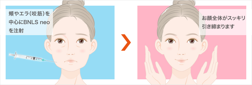 BNLS アルティメット注射