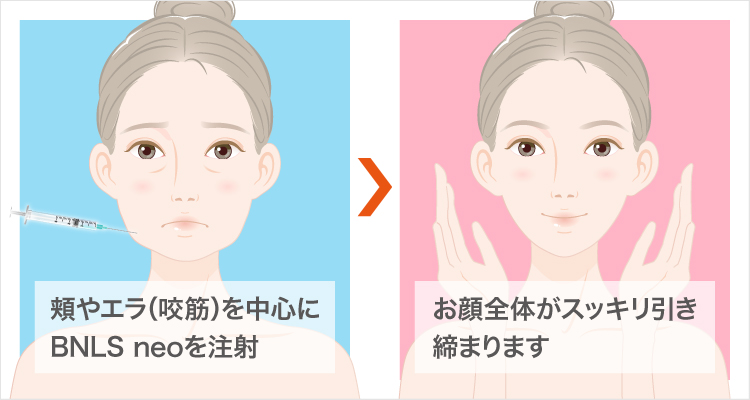 BNLS アルティメット注射