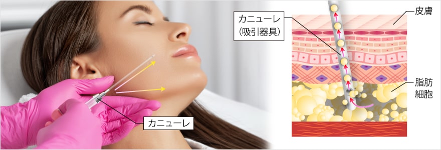 小顔術（脂肪吸引）