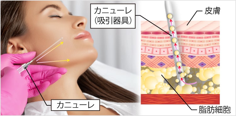 小顔術（脂肪吸引）