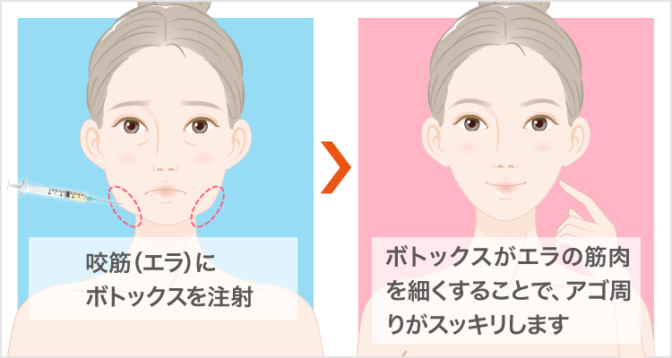 エラボトックス小顔注射方法