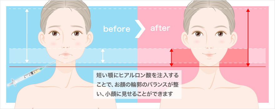 あごのヒアルロン酸小顔注射