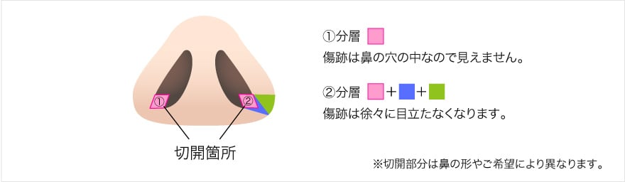 鼻翼内側切開と鼻翼外側切開