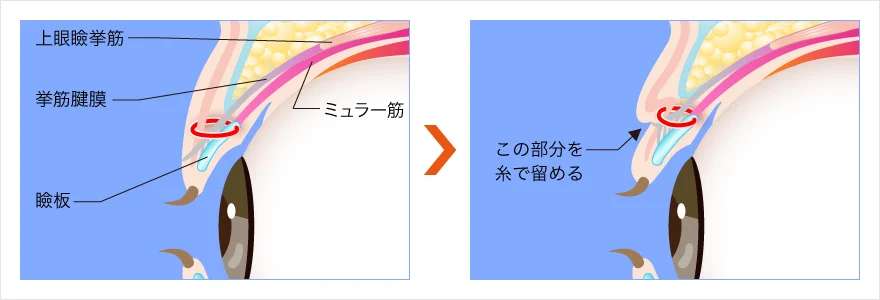 瞼板法（青春二重術）