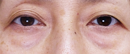 切開法による目の下のたるみ取り（下眼瞼除皺術）症例写真04_before