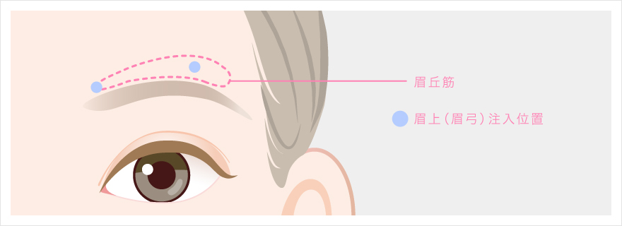 眉上（眉弓）のボトックス注射