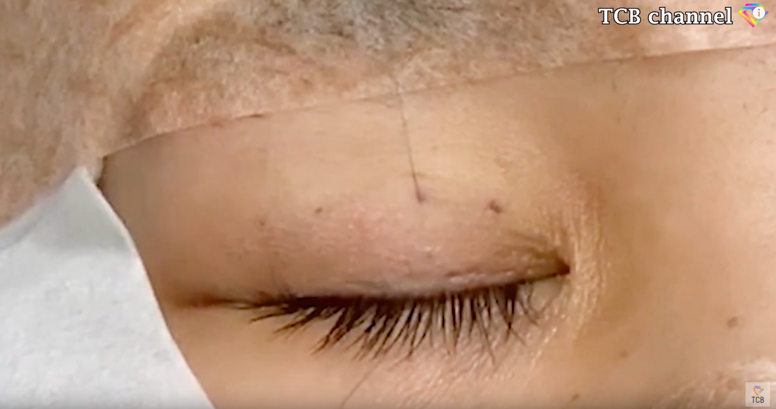 マーキングに忠実な手術