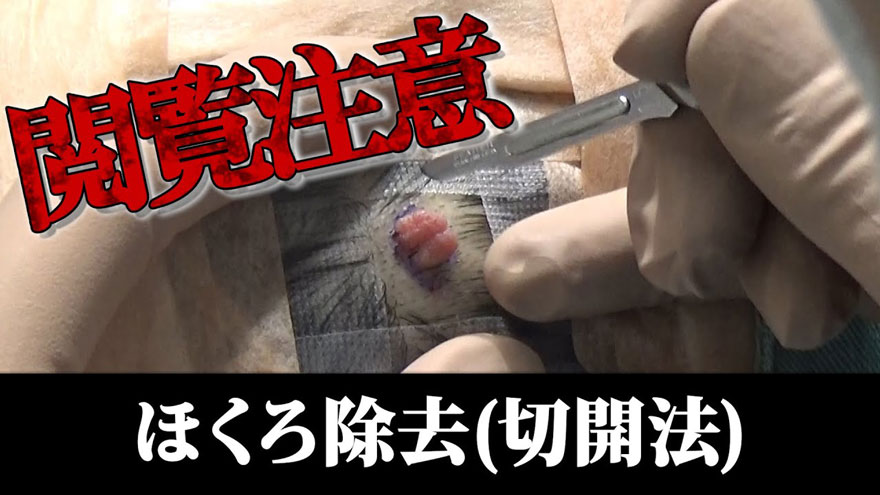 煩わしい頭のイボを完全切除！TCB特別指導医・形成外科専門医Dr.もみーによる頭のほくろ切除術を大公開！