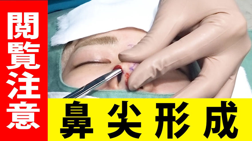 【大公開】お手軽！鼻整形（TCBメッシュ・TCB式鼻先尖鋭術）