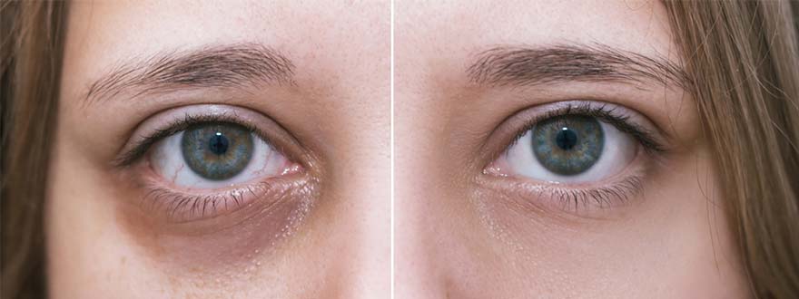 目の下のクマの原因