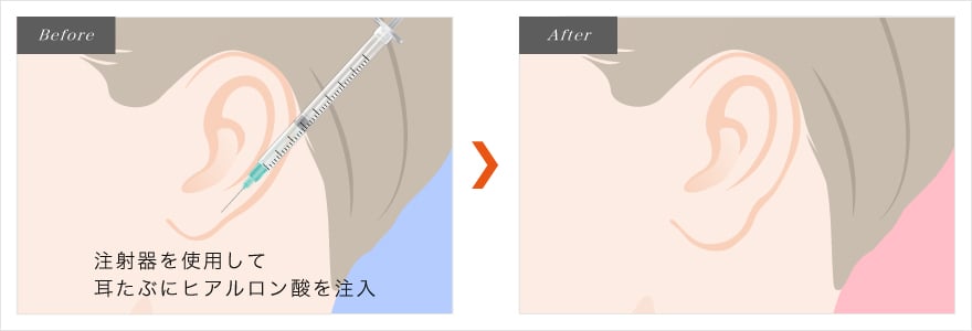 耳たぶのヒアルロン酸注射