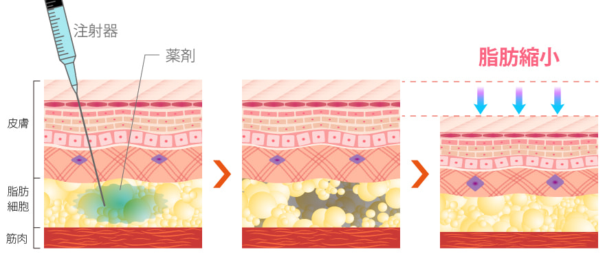 脂肪溶解注射で脂肪細胞が溶かされる様子