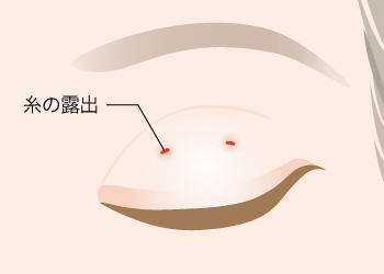 まぶたの表から糸が出ている場合のリスク