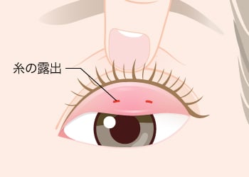 まぶたの裏（眼球側）から糸が出ている場合のリスク