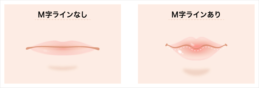 M字ラインのなし・あり