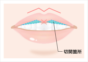 M字リップの施術シーン
