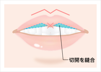M字リップの縫合シーン