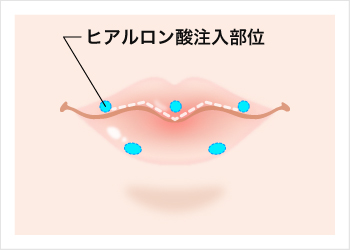 M字のリップにする際のヒアルロン酸注入部位