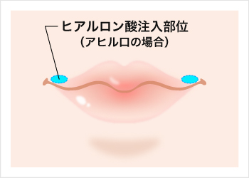 アヒル口整形のときのヒアルロン酸注入部位