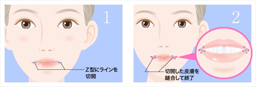 口角挙上の施術