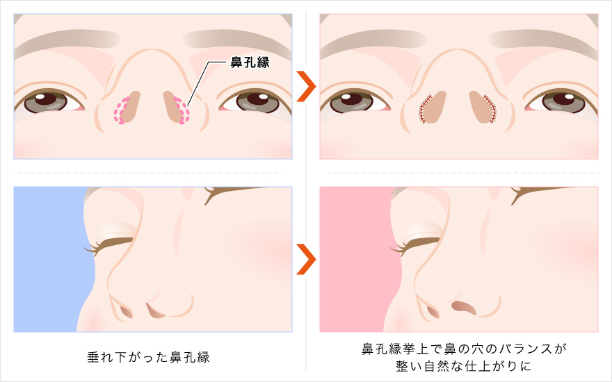 鼻孔縁挙上で鼻の穴のバランスが整う