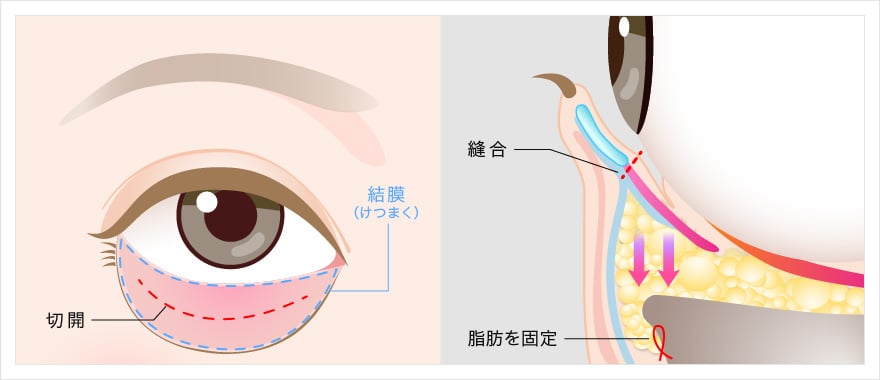 裏ハムラ法