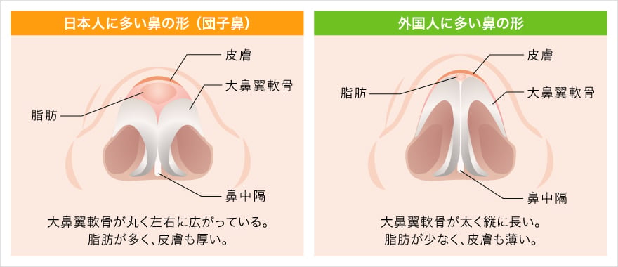 鼻尖形成完全閉鎖法が優れている理由